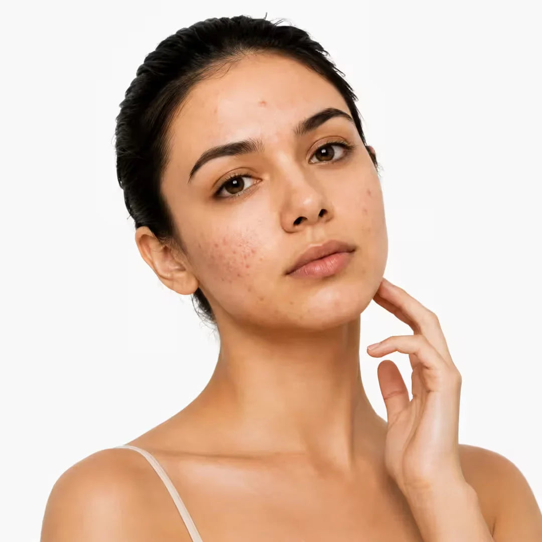 Acne & Blemishes